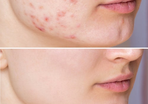 Achieve Flawless Everyday Makeup with Expert Acne Treatments